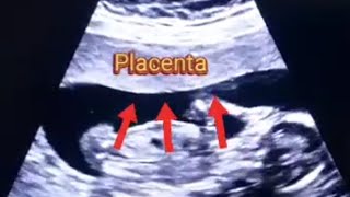 Anterior Placenta with baby Boy  Posterior Placenta with baby Girl  Baby genders and 3 vessel cord [upl. by Pazit207]