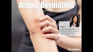 Atopic Dermatitis VisualDx Clinical Education Series [upl. by Nednil]