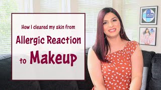 Allergic reaction to makeup  How to clear skin after an allergic reaction  Makeup allergy [upl. by Raney]