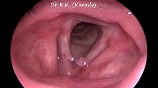 Video Laryngoscopy  How Vocal Polyp Look Like [upl. by Pooley]