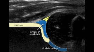 Congenital Hipdysplasia  Ultrasound Anatomy [upl. by Tannenwald]