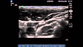 INTERMEDIATE CERVICAL SUPERFICIAL CERVICAL PLEXUS BLOCK [upl. by Lorsung]