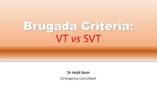 Brugada criteria How to differentiate VT from SVT [upl. by Schaffer]