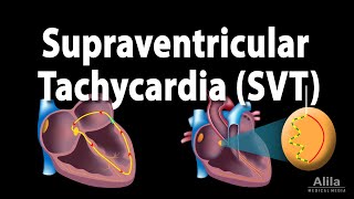 Supraventricular Tachycardia SVT PSVT Animation [upl. by Eiramasil]