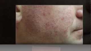 What is Amoxicillin Rash Amoxicillin Rash Pictures [upl. by Willette447]