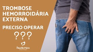 Trombose hemorroidária externa precisa de cirurgia [upl. by Felise909]