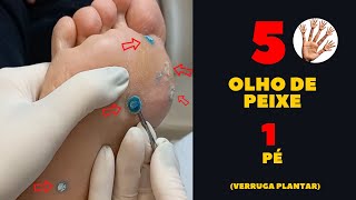 VERRUGA PLANTAR “olho de peixe” O que você precisa saber Por Luiz Gameiro dermatologista [upl. by Wallace]