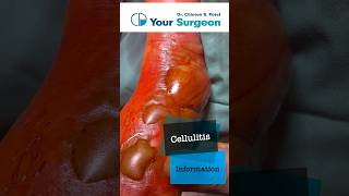 Cellulitis  Complete Information  What is Cellulitis  Treatment Options  Reasons  Debridement [upl. by Ydnor]