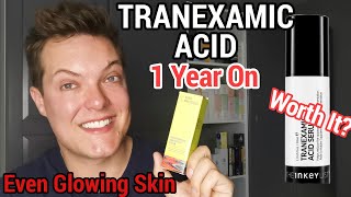 TRANEXAMIC ACID  12 Month Update  Did It Fade My Acne Scars [upl. by Eelamme]