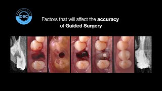 ACCURACY OF GUIDED SURGERY COMMON MISTAKES PART 1 [upl. by Ambros]