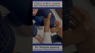 Clubfoot can correctable ll clubfoottreatment clubfoot treatment Congenital Talipes Equinovarus [upl. by Mayes]