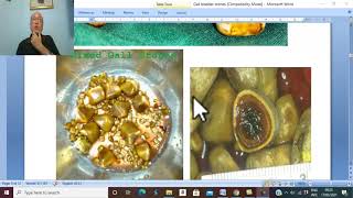 Biliary disorders in Arabic 1  Types of Gall Bladder Stones   by Dr Wahdan [upl. by Eirahs]