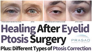 Different Types of Eyelid Ptosis Surgical Correction Techniques and Expected Healing Time [upl. by Hayn]