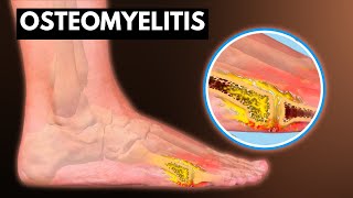 Osteomyelitis What You Need To know [upl. by Jorrie]