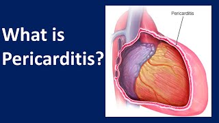 What is Pericarditis [upl. by Aissila]