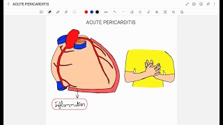 ACUTE PERICARDITIS [upl. by Stoops]