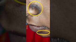 Seborrheic Melanosis 😱 shorts youtubeshorts doctorskin shortsfeed [upl. by Kerek750]