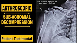 ARTHROSCOPIC SUBACROMIAL DECOMPRESSION PATIENT TESTIMONIAL [upl. by Kori]