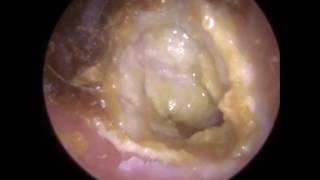 194 Eardrum about to EXPLODE after Blocked Ear Wax Removal using Endoscopic Ear Microsuction [upl. by Bette609]