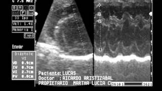 insuficiencia valvular mitral y tricuspideawmv [upl. by Lesna]