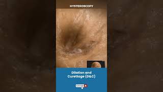 बच्चेदानी Uterus का Dilation और Curettage  Procedure for removing unwanted tissue in uterus [upl. by Maurie]