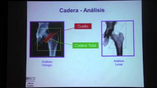 Desintometría Ósea Interpretación DEXA posición oficial de la ISCD [upl. by Kellyn]