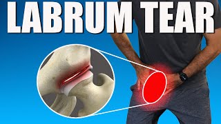 HIP LABRUM TEAR BEST Exercises Stretches amp Advice for Hip amp Groin Pain Relief [upl. by Theall]