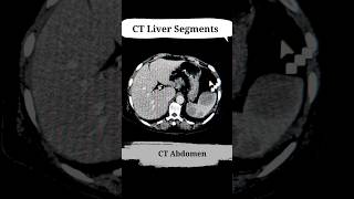 liver segments on ct scan radiology ctscan anatomy education [upl. by Eleazar]