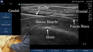 USGuided Fascia Iliaca Block FULL VIDEO LINK BELOW [upl. by Aivalf]