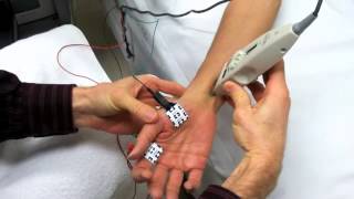 Median Motor Nerve Conduction Study [upl. by Nymrak]