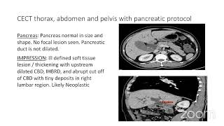 PG CLINICS OBSTRUCTIVE JAUNDICE [upl. by Hgielsa]