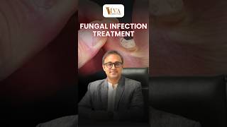 How long fungal infection treatment will take  Dr Deepam Shah [upl. by Eilsil]