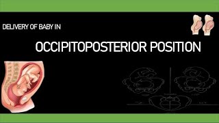 Delivery of Baby in Occipitoposterior Position [upl. by Roseanna]