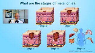 What are the stages of melanoma [upl. by Eahsel]