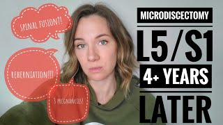 Update 4 years after microdiscectomy at L5S1 Reherniation [upl. by Ahsinrats435]