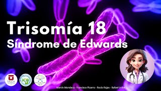 Trisomía 18 ‐ Síndrome de Edwards [upl. by Nnylrahc508]