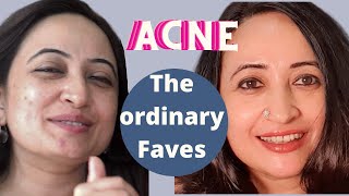 The Ordinary Skincare Products For Acne Scars amp acne Best skincare Products in India NOW [upl. by Dunton]