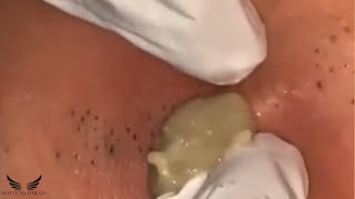 Severe Cystic Acne Treatment  Back Acne Blackheads Removal  Pimple Popping Spa Extraction  017 [upl. by Domonic]