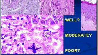 Medical School Pathology Chapter 7n [upl. by Lleinad]