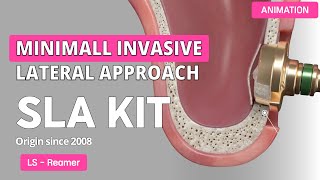 SLA Kit  Sinus Lateral Approach Kit [upl. by Thorncombe]