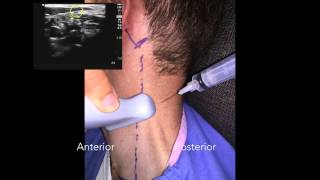 Cevical Plexus Nerve Block [upl. by Adlesirg438]