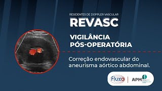 Doppler na Vigilância pósoperatória de correção endovascular do aneurisma da aorta  REVASC [upl. by Carmelle584]