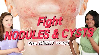 How To Get Rid of Nodular and Cystic Acne FOR GOOD  Root Times Acne Guide [upl. by Pearlman]