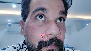 pimple patch removal  pimple patch removal on acne [upl. by Calabrese945]