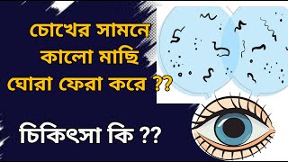 What are Floaters in eyes causes and treatment  Vitreous floaters eye eyefloaters eyeflashes [upl. by Reggi]