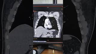 CT Chest with Contrast What to Expect anatomy cardiacimaging brainhealth [upl. by Asiled]