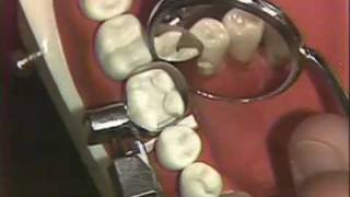 Packing of Class II Amalgam for Hygienists [upl. by Dareg]