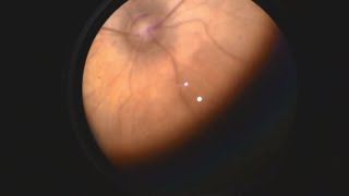 Retinopathy of Prematurity [upl. by Ethben]