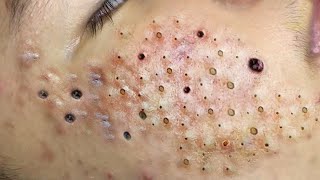 Big Cystic Acne Blackheads Extraction Blackheads amp Milia Whiteheads Removal Pimple Popping  5713 [upl. by Alcine]