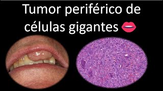 👄 Tumor periférico de células gigantes  Cavidad oral  Cabeza y Cuello  Patología [upl. by Ardnuek]